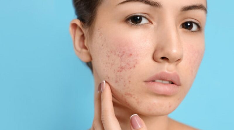 Best Acne Treatment For Sensitive Skin - Reaching World Live